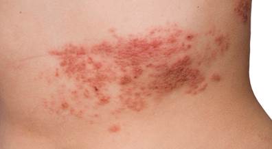 Herpes Zoster Vaccine Rates Improved With Tracking System Herpes Zoster Vaccine Rates Improved With Tracking System