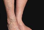 Blue skin in an elderly woman Blue skin in an elderly woman