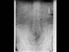 Ortho Dx: Chronic lower back pain after traumatic fall Ortho Dx: Chronic lower back pain after traumatic fall