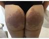 Derm Dx: Progressive discoloration of the buttocks Derm Dx: Progressive discoloration of the buttocks