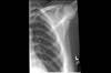 Ortho Dx: A teenager falls off his friend's shoulders Ortho Dx: A teenager falls off his friend's shoulders