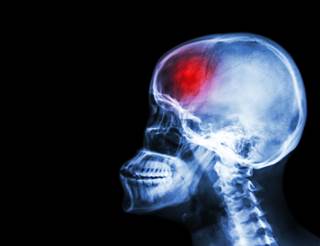 Moderate optimism may be protective against the risk of new-onset depression in women who have a stroke. Moderate optimism may be protective against the risk of new-onset depression in women who have a stroke.