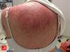 Image of the Week: Which malignancy is the greatest risk for this patient? Image of the Week: Which malignancy is the greatest risk for this patient?