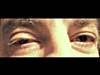 Derm Dx: Ptosis following an outpatient cosmetic procedure Derm Dx: Ptosis following an outpatient cosmetic procedure