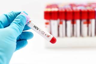 Hepatitis C virus infection is associated with cancers other than hepatocellular carcinoma. Hepatitis C virus infection is associated with cancers other than hepatocellular carcinoma.