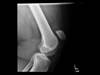 Ortho Dx: Is this a patella alta or a patella baja? Ortho Dx: Is this a patella alta or a patella baja?
