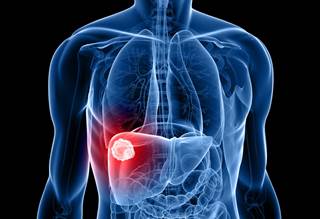 Investigators have proposed an algorithm to facilitate the decision-making process of clinical care for patients with very early HCC. Investigators have proposed an algorithm to facilitate the decision-making process of clinical care for patients with very early HCC.
