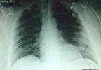 Case Study in Urgent Care: Leg edema and shortness of breath Case Study in Urgent Care: Leg edema and shortness of breath