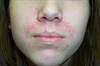 Derm Dx: A rash about the mouth and chin Derm Dx: A rash about the mouth and chin