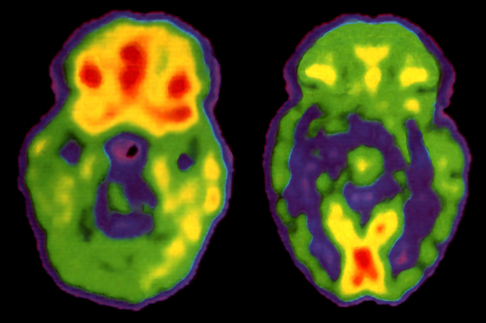 anemona hartocollis schizophrenia