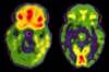 Schizophrenia: a clinical overview Schizophrenia: a clinical overview