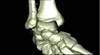 Ortho Dx: A rare foot injury Ortho Dx: A rare foot injury