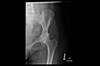 Ortho Dx: Avascular necrosis of the hip Ortho Dx: Avascular necrosis of the hip