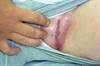Derm Dx: Distressing male groin lesions Derm Dx: Distressing male groin lesions