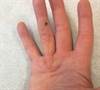 Ortho Dx: Progressive flexion deformity of the finger Ortho Dx: Progressive flexion deformity of the finger