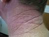 Derm Dx: Geometrically arranged furrows on the neck Derm Dx: Geometrically arranged furrows on the neck