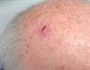 Derm Dx: A new scalp lesion in a man with a history of cancer Derm Dx: A new scalp lesion in a man with a history of cancer