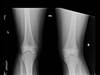 Ortho Dx: A girl with knee pain when she jumps and runs Ortho Dx: A girl with knee pain when she jumps and runs