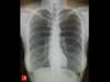 Image of the Week: Which pulmonary function test findings would you expect? Image of the Week: Which pulmonary function test findings would you expect?