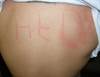 Derm Dx: Why would this word appear on this man's back? Derm Dx: Why would this word appear on this man's back?