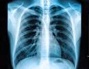Improving Lung Function in COPD With Indacaterol/Glycoptrrolate Inhaler Improving Lung Function in COPD With Indacaterol/Glycoptrrolate Inhaler