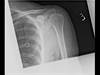 Ortho Dx: The treatment dilemma with partial rotator cuff tears Ortho Dx: The treatment dilemma with partial rotator cuff tears
