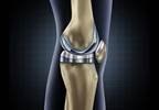 Total knee replacement for osteoarthritis has minimal effect on quality of life Total knee replacement for osteoarthritis has minimal effect on quality of life