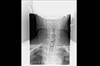 Ortho Dx: Which finding indicates cervical myelopathy? Ortho Dx: Which finding indicates cervical myelopathy?