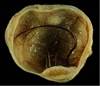 An unusual pelvic mass in a 43-year-old woman An unusual pelvic mass in a 43-year-old woman