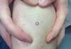 Derm Dx: Itchy bumps on a man who uses a hot tub regularly Derm Dx: Itchy bumps on a man who uses a hot tub regularly