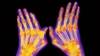 Rheumatoid arthritis: risk factors, clinical signs, and treatment Rheumatoid arthritis: risk factors, clinical signs, and treatment