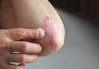 Severe Adrenal Deficiency With Topical Steroid Application for Psoriasis Severe Adrenal Deficiency With Topical Steroid Application for Psoriasis