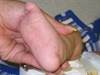 Derm Dx: A baby with a rash on the hands and feet Derm Dx: A baby with a rash on the hands and feet