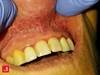 Image of the Week: What's causing this distinctive mucosal pattern? Image of the Week: What's causing this distinctive mucosal pattern?