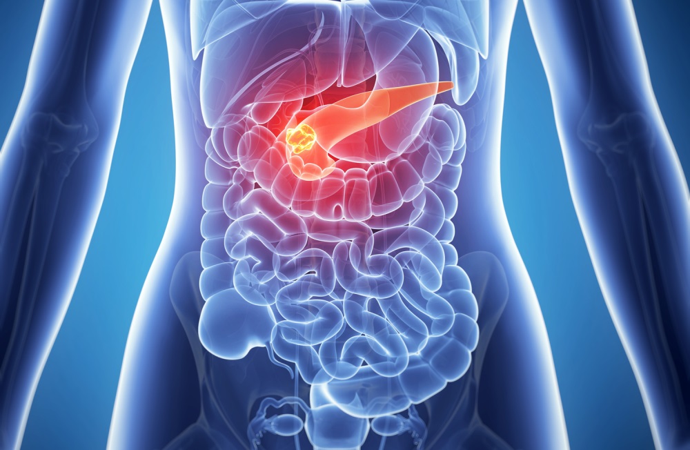 Advanced pancreatic cancer treatment