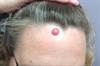 Derm Dx: An enlarging erythematous nodule on the forehead Derm Dx: An enlarging erythematous nodule on the forehead