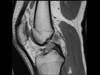 Ortho Dx: Which graft would you choose to reconstruct this ACL? Ortho Dx: Which graft would you choose to reconstruct this ACL?