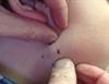 Derm Dx: A firm nodule with a positive skin crease sign Derm Dx: A firm nodule with a positive skin crease sign