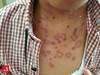 Image of the Week: A dead cat, a sick child, and an unusual rash Image of the Week: A dead cat, a sick child, and an unusual rash