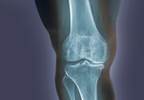 Metabolic syndrome not linked to knee osteoarthritis Metabolic syndrome not linked to knee osteoarthritis