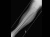 Ortho Dx: A fibula fracture with ankle swelling Ortho Dx: A fibula fracture with ankle swelling