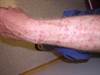 Derm Dx: Extensive sun exposure and red lesions on the arms and legs Derm Dx: Extensive sun exposure and red lesions on the arms and legs