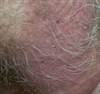 Derm Dx: Purplish scrotal lesions in a man with hypertension Derm Dx: Purplish scrotal lesions in a man with hypertension