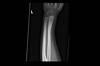 Ortho Dx: Pediatric plastic deformation Ortho Dx: Pediatric plastic deformation