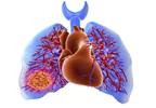 Surgical pulmonary embolectomy for thrombus distribution is feasible, effective Surgical pulmonary embolectomy for thrombus distribution is feasible, effective