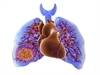 Surgical pulmonary embolectomy for thrombus distribution is feasible, effective Surgical pulmonary embolectomy for thrombus distribution is feasible, effective