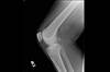 Ortho Dx: A calcified mass in the back of the knee Ortho Dx: A calcified mass in the back of the knee