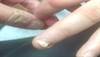 Derm Dx: Whitening and crumbling of fingernails Derm Dx: Whitening and crumbling of fingernails