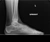 Ortho Dx: Increased forefoot pain when metatarsal heads squeezed Ortho Dx: Increased forefoot pain when metatarsal heads squeezed