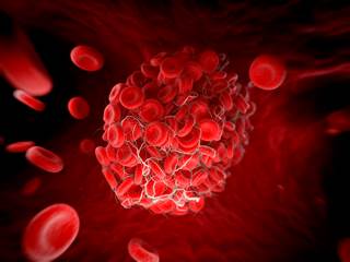 Anticoagulation therapy may be cost-effective for patients with a predicted 1-year VTE risk of 17.5% or more. Anticoagulation therapy may be cost-effective for patients with a predicted 1-year VTE risk of 17.5% or more.